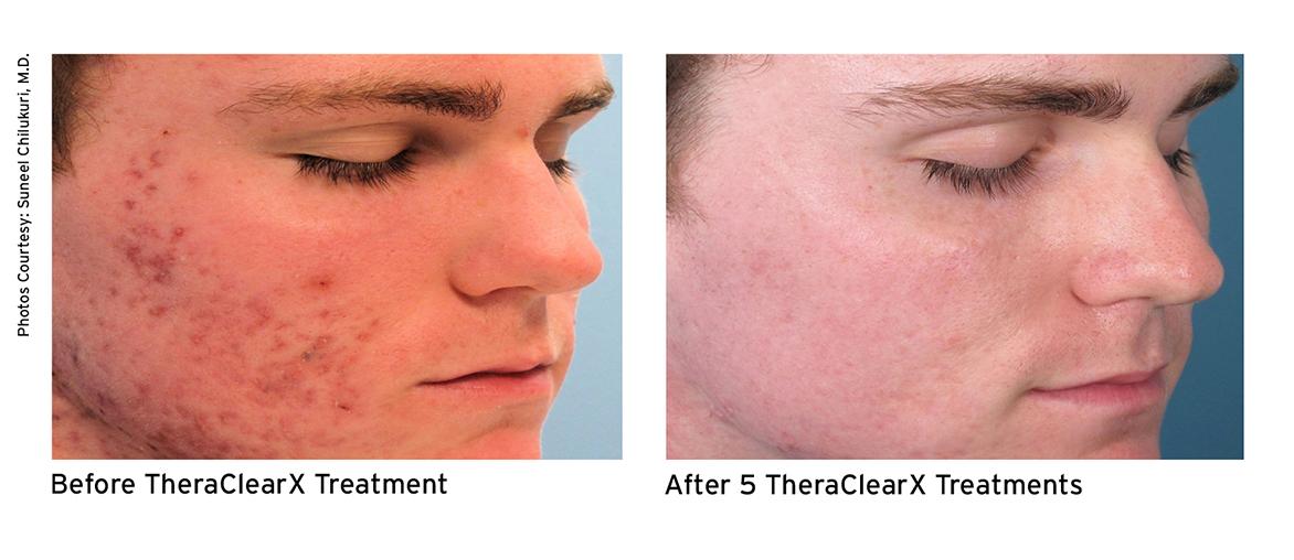 TheraClear®X Treatment in Melbourne, Tampa and Palm Bay, FL